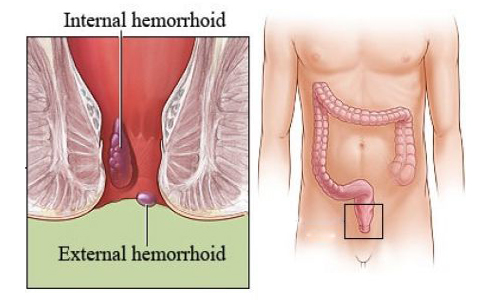 Can hemorrhoids cause constipation?